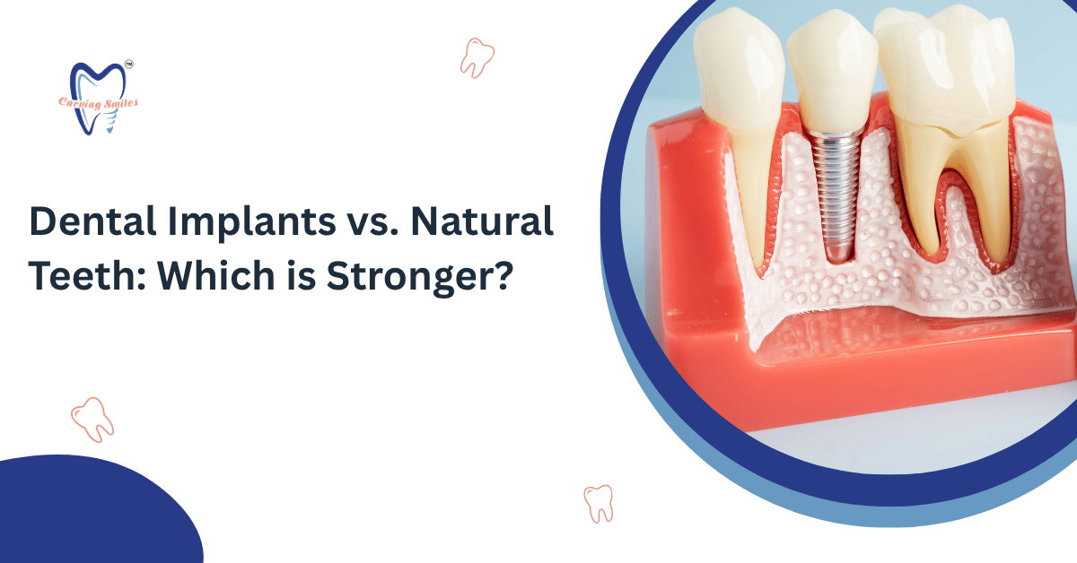 Dental Implants vs. Natural Teeth Which is Stronger