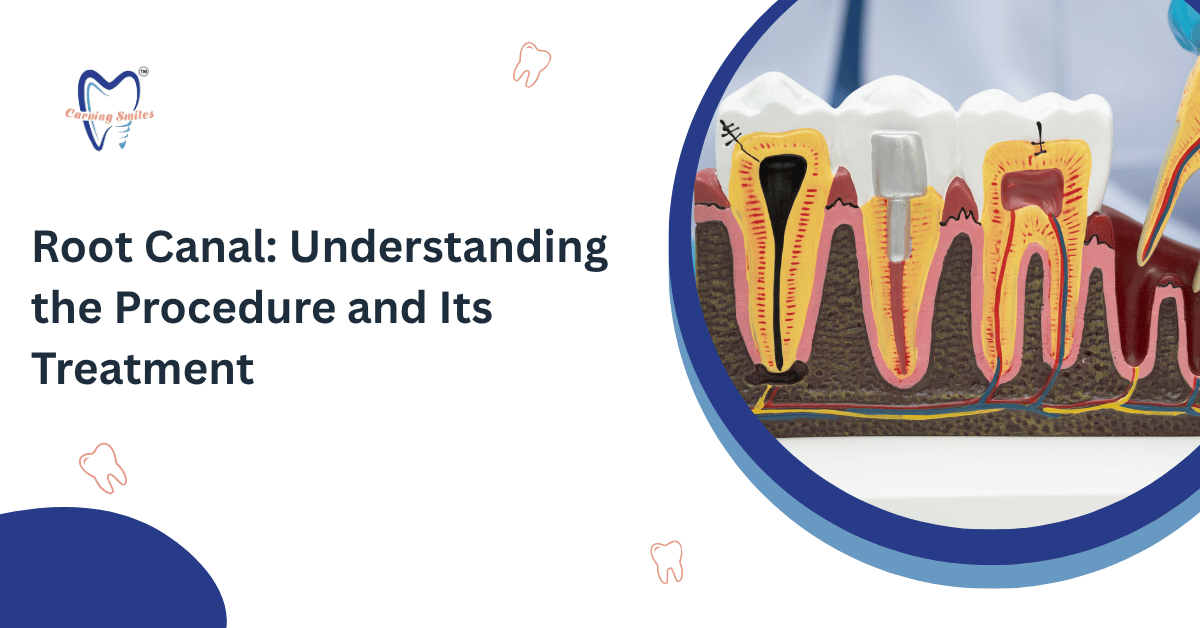 Root Canal: Understanding the Procedure and Its Treatment