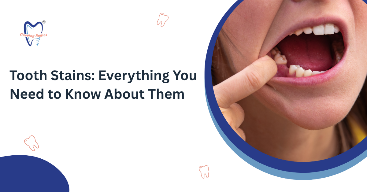 Tooth Stains: Everything You Need to Know About Them