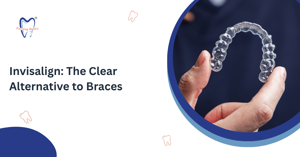 Invisalign: The Clear Alternative to Braces