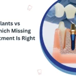 Dental Implants vs Bridges