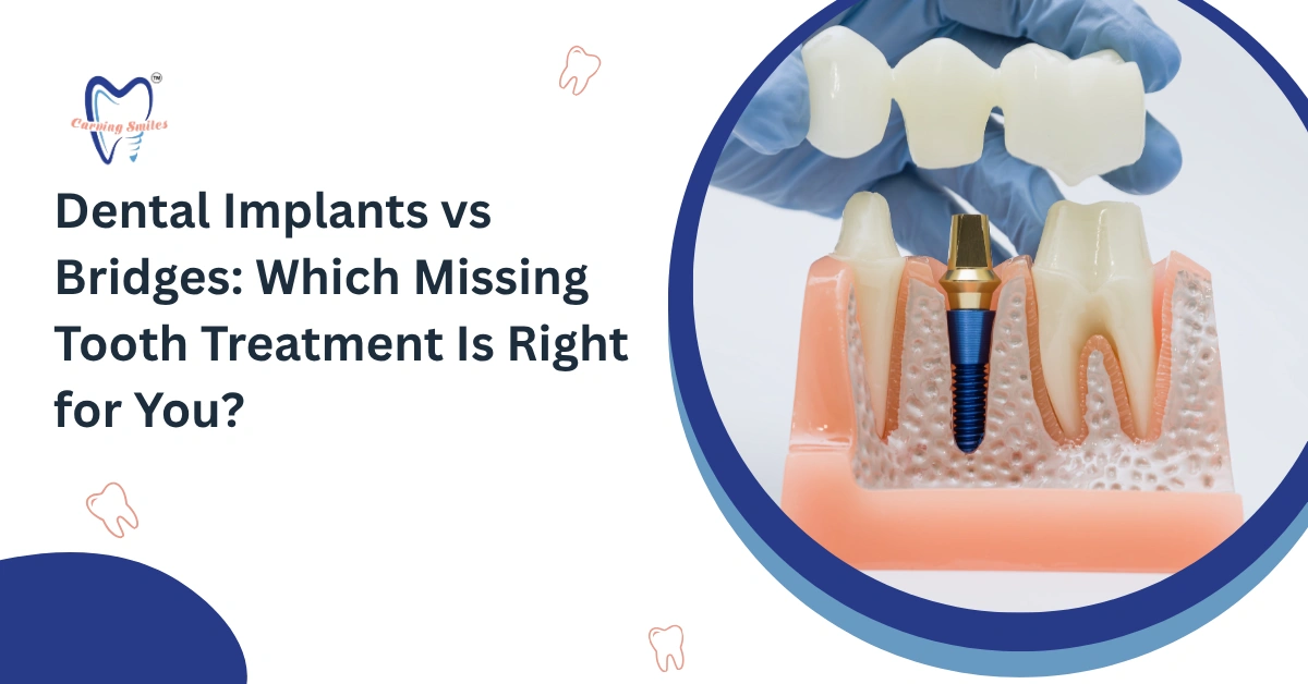 Dental Implants vs Bridges