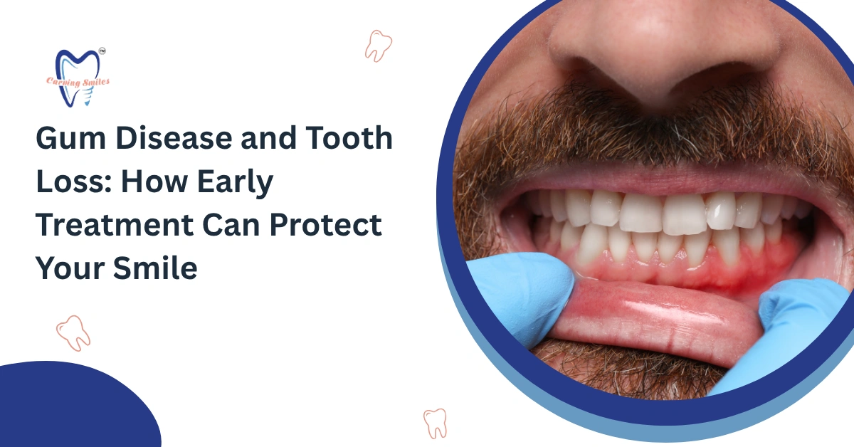 Gum Disease and Tooth Loss: Early Treatment Tips