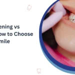 Teeth Whitening vs Veneers: Which Is Right for You?