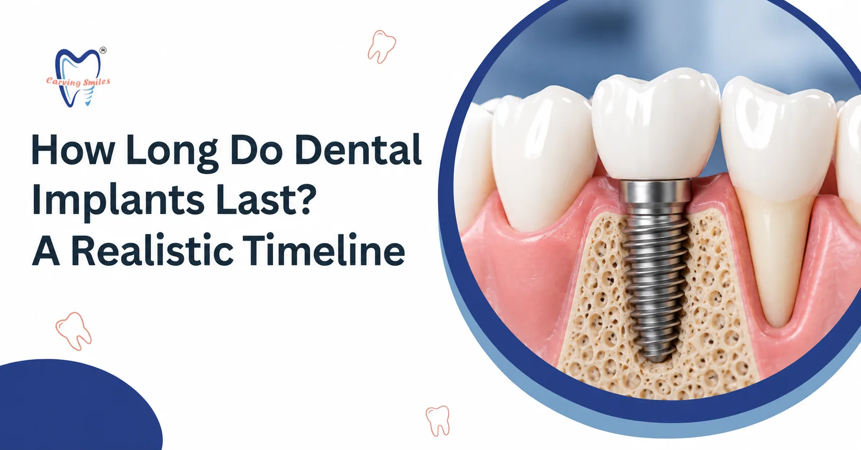 How Long Do Dental Implants Last? A Realistic Timeline