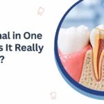 Root Canal In One Sitting: Is It Really Possible?