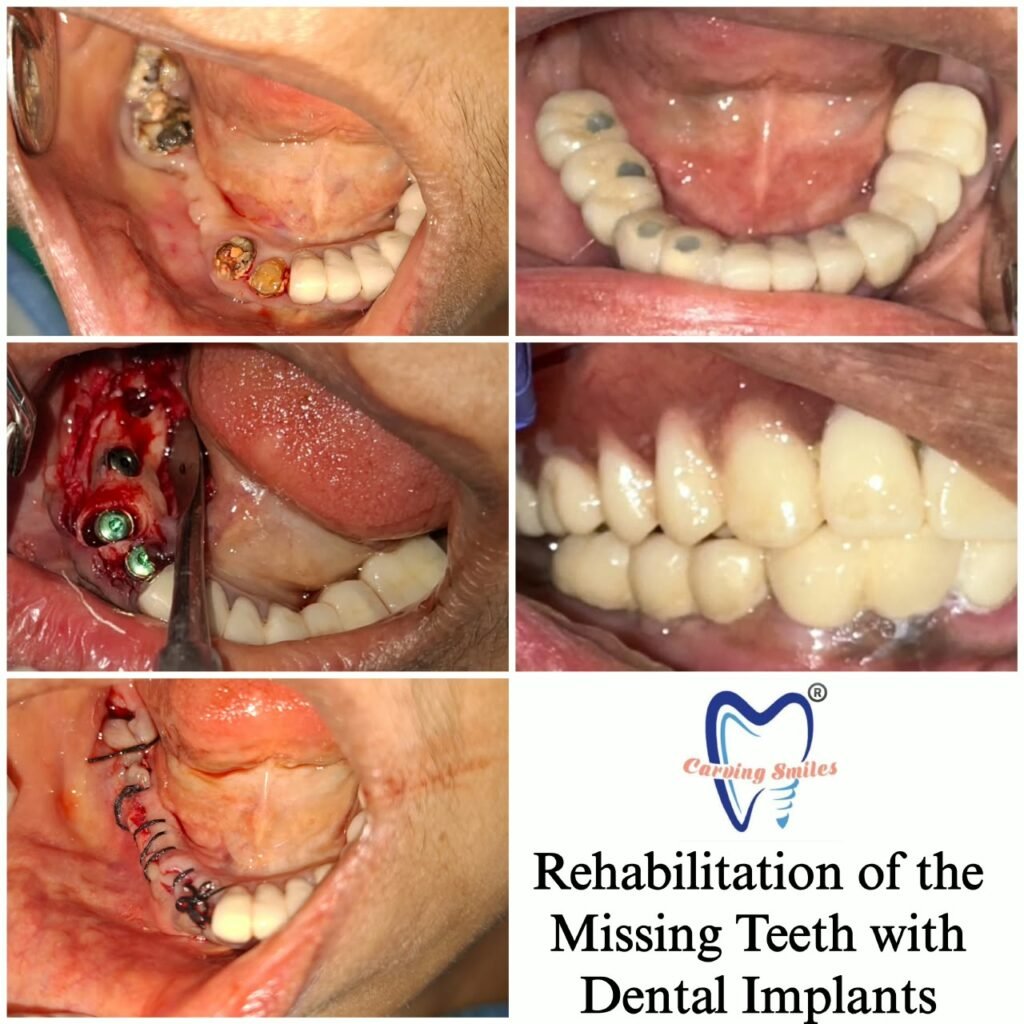 Dental Implants – Rehabilitation of Missing Teeth