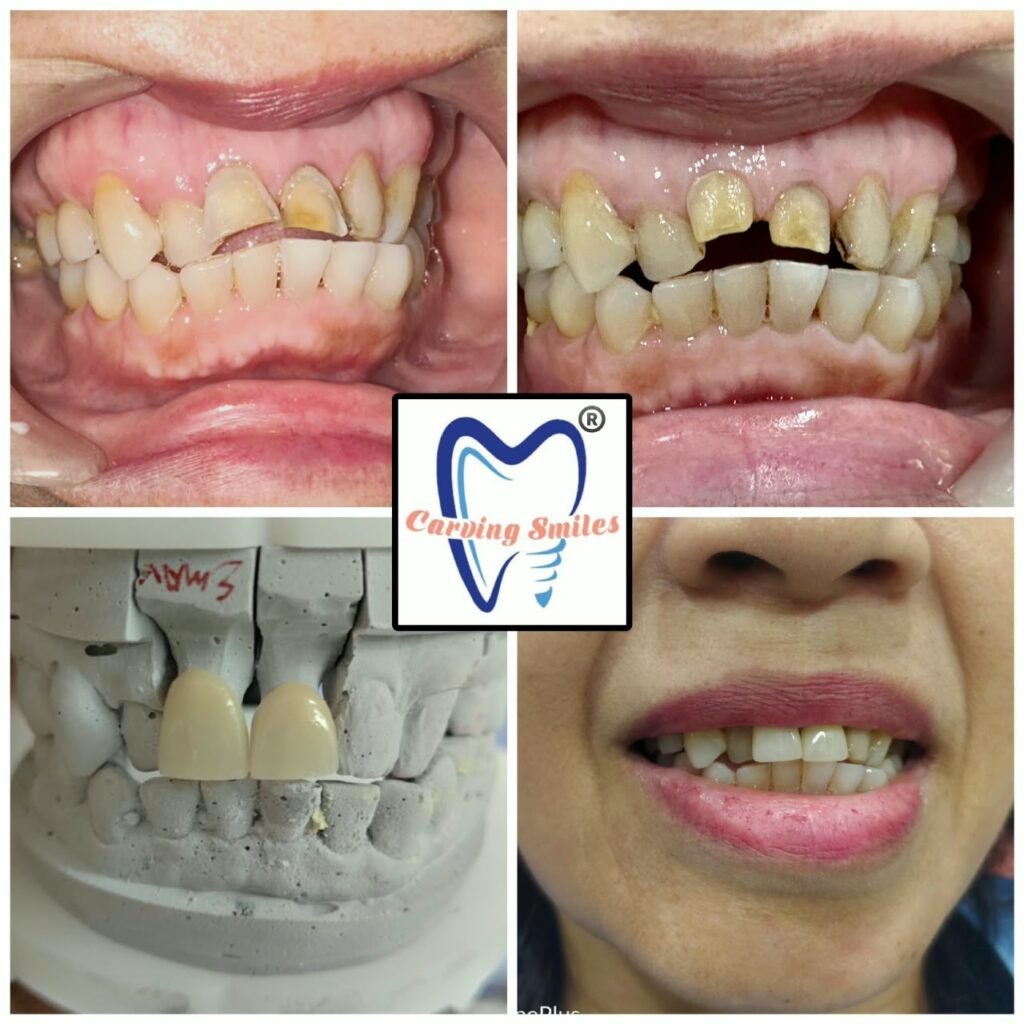 Dental Crownsand Smile Restoration Treatment Carving Smiles Dental Clinic in Chembur