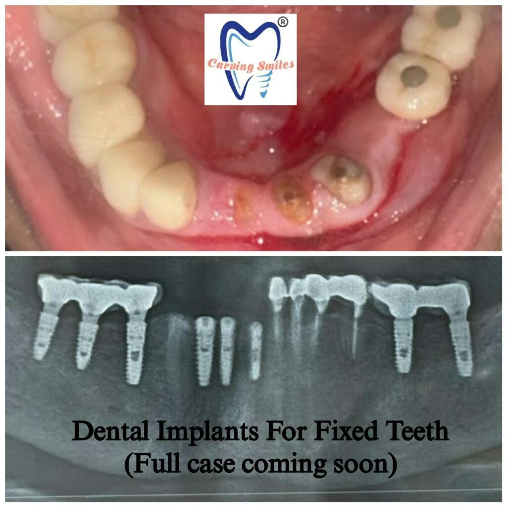 dental-implants-for-fixed-teeth-Carving-Smiles-Chembur